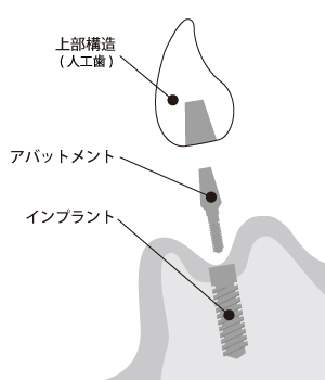 インプラントについて