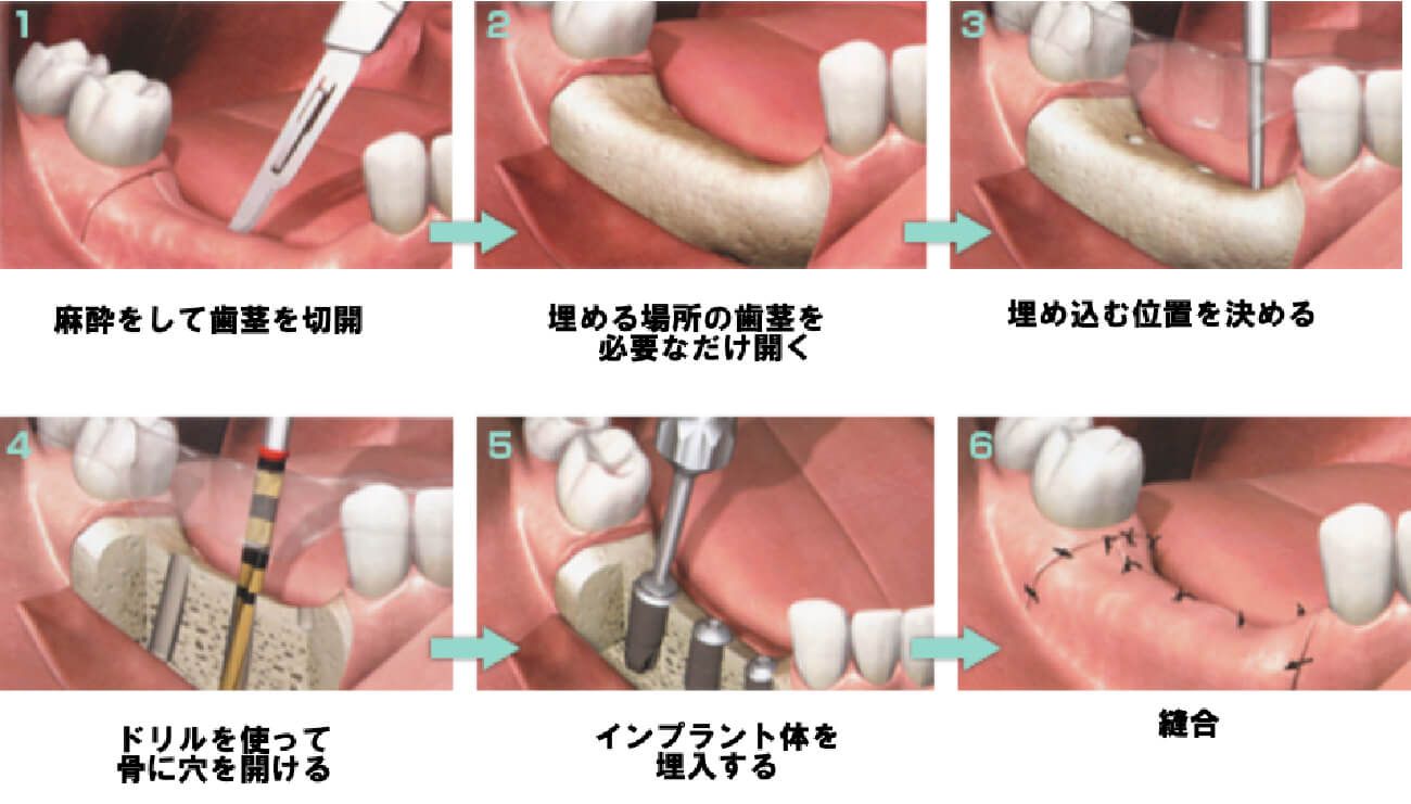 インプラント埋め込み