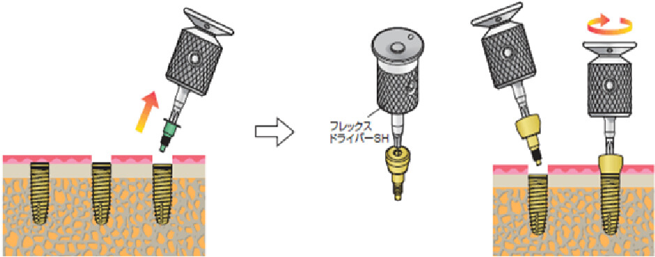 インプラント埋め込み