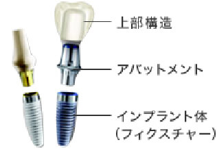 インプラント部品