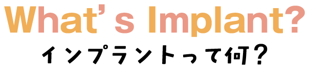 インプラントって何
