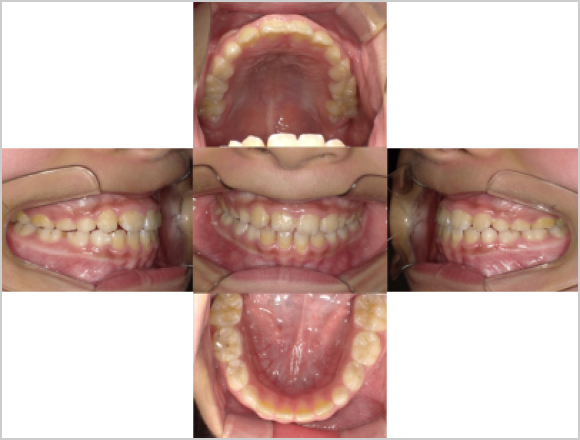 受け口（反対咬合）と狭窄歯列の改善 後