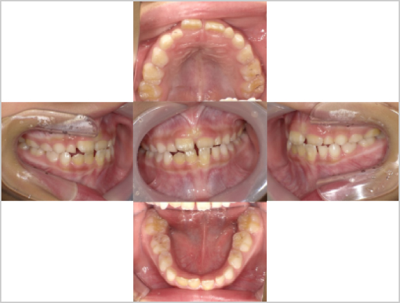 受け口（反対咬合）と狭窄歯列の改善 前